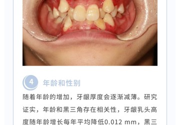 【口腔科普】正畸中的“黑三角”是怎么形成的？