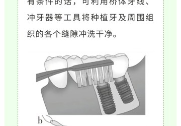 您的种植牙正确维护了吗？