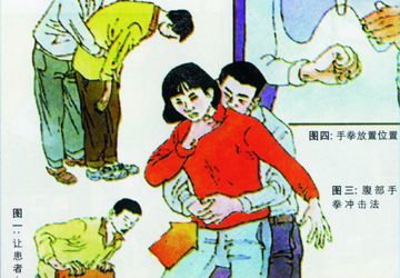 气道异物的急救