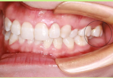 【口腔科普】后牙伸长不用怕，压低有妙招！